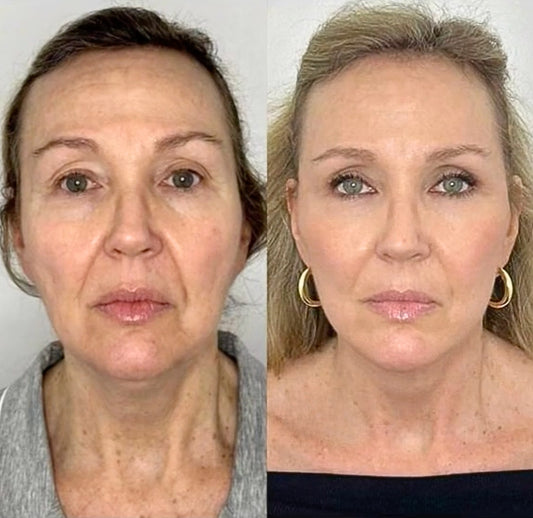 IN OFFERTA: Kit Oro 24k 5 IN 1 con Acido Ialuronico e Bava di Lumaca