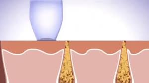 Aspiratore punti neri