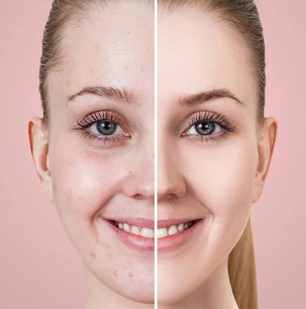 Aspiratore punti neri